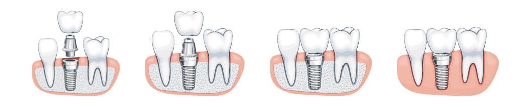 clinica-dental-poblesec-implantes