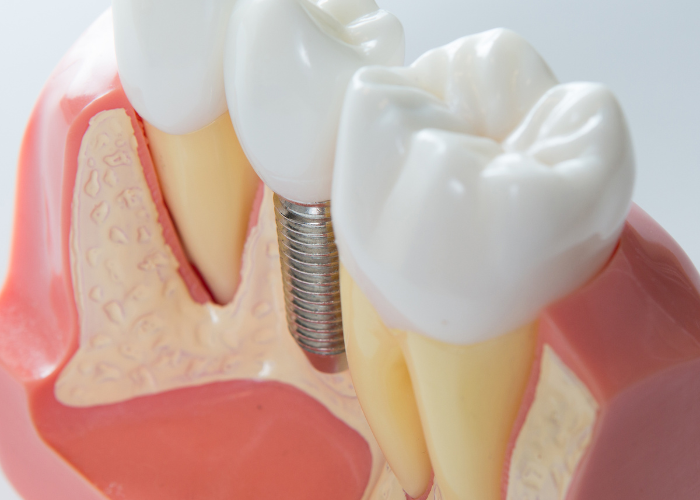 clinica-dental-poblesec-implantes